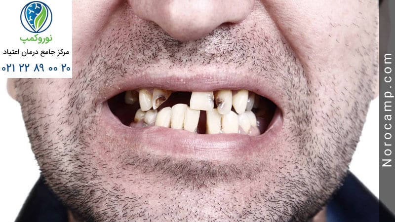 دندان‌های پوسیده و زرد رنگ از عوارض مصرف تریاک